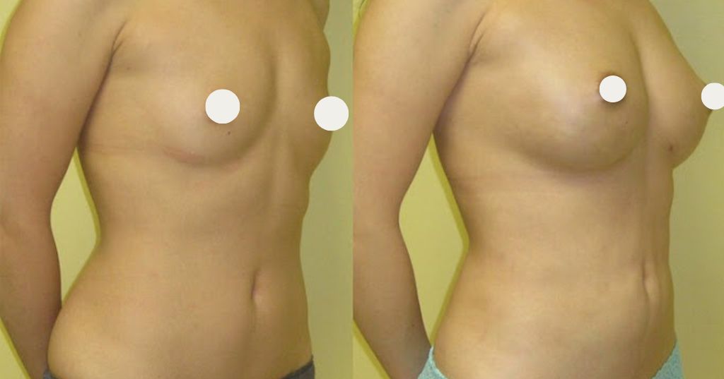 Gynecomastia before and after results