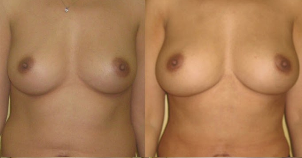 Before and after result