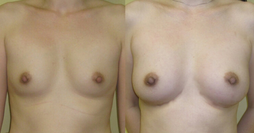 Before and after result