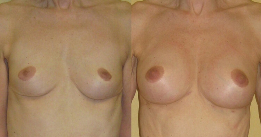 Before and after result