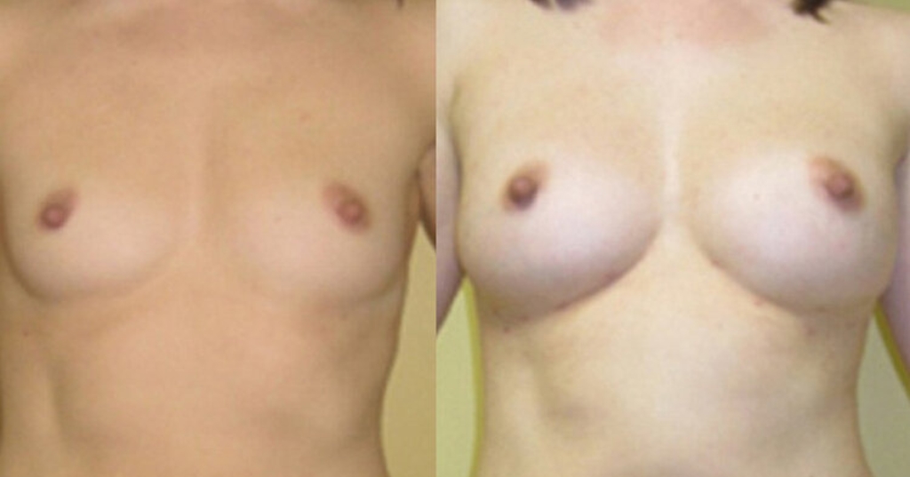 Before and after result