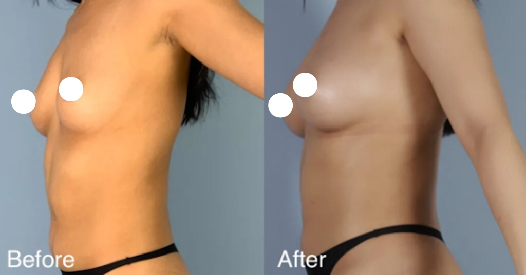Gynecomastia before and after