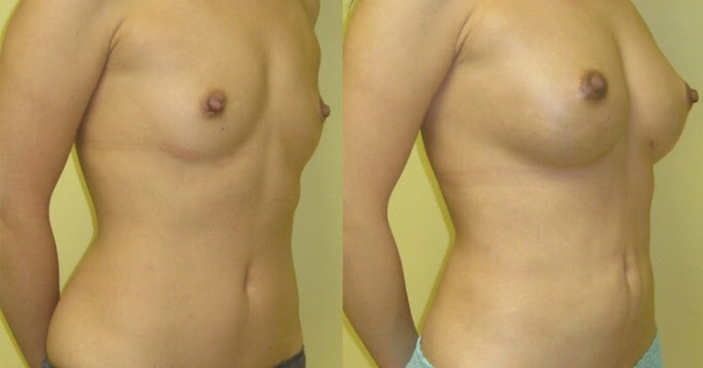 Before and after result