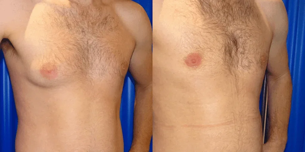 Gynecomastia before and after
