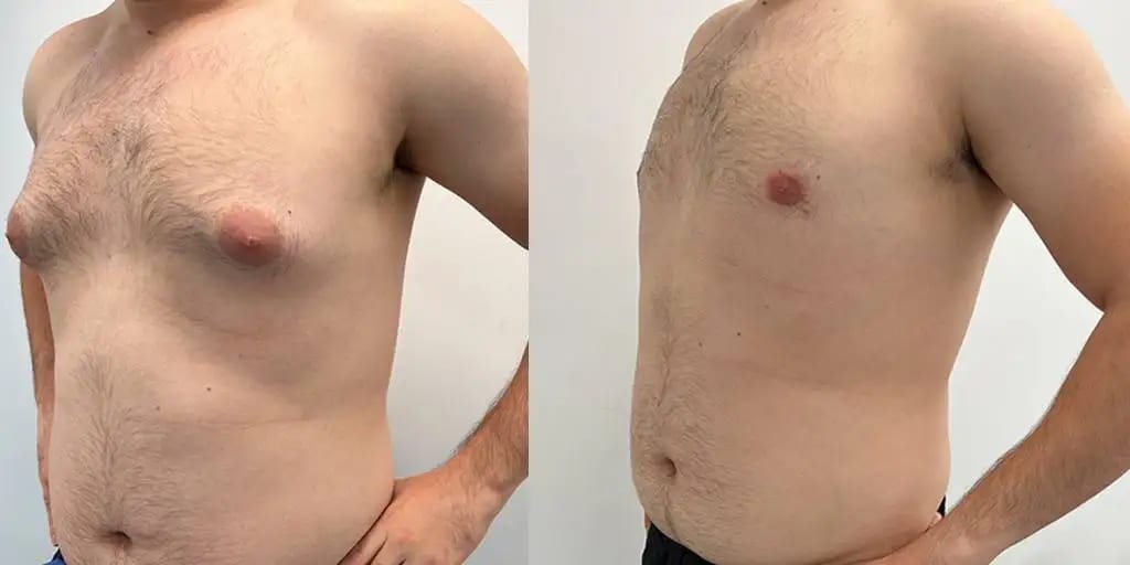Gynecomastia before and after