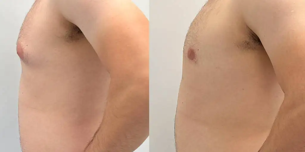 Gynecomastia before and after