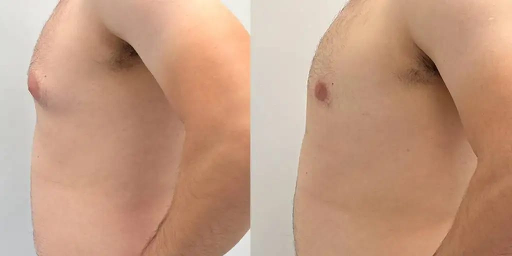 Gynecomastia before and after