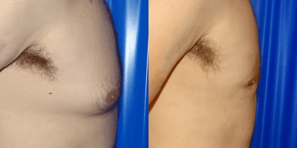 Gynecomastia before and after