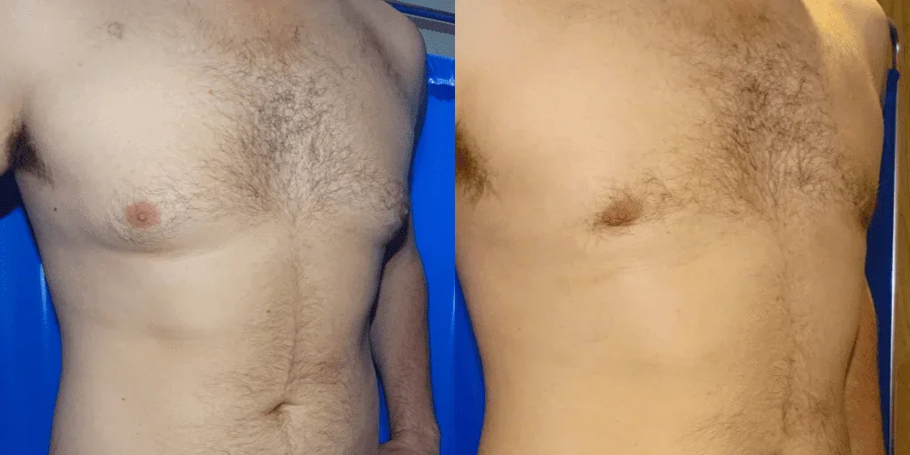 Gynecomastia before and after