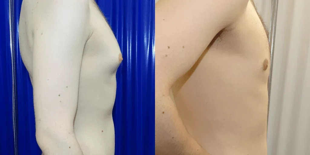 Gynecomastia before and after