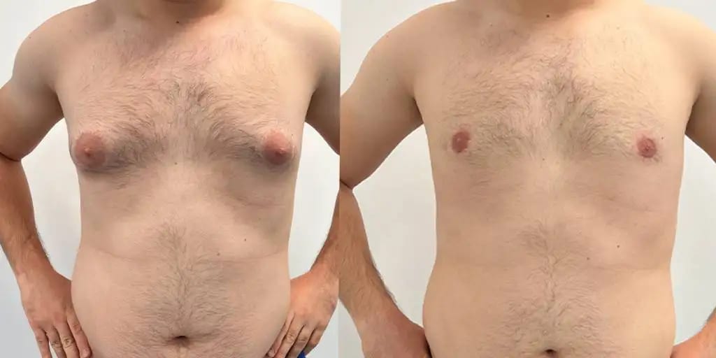 Gynecomastia before and after
